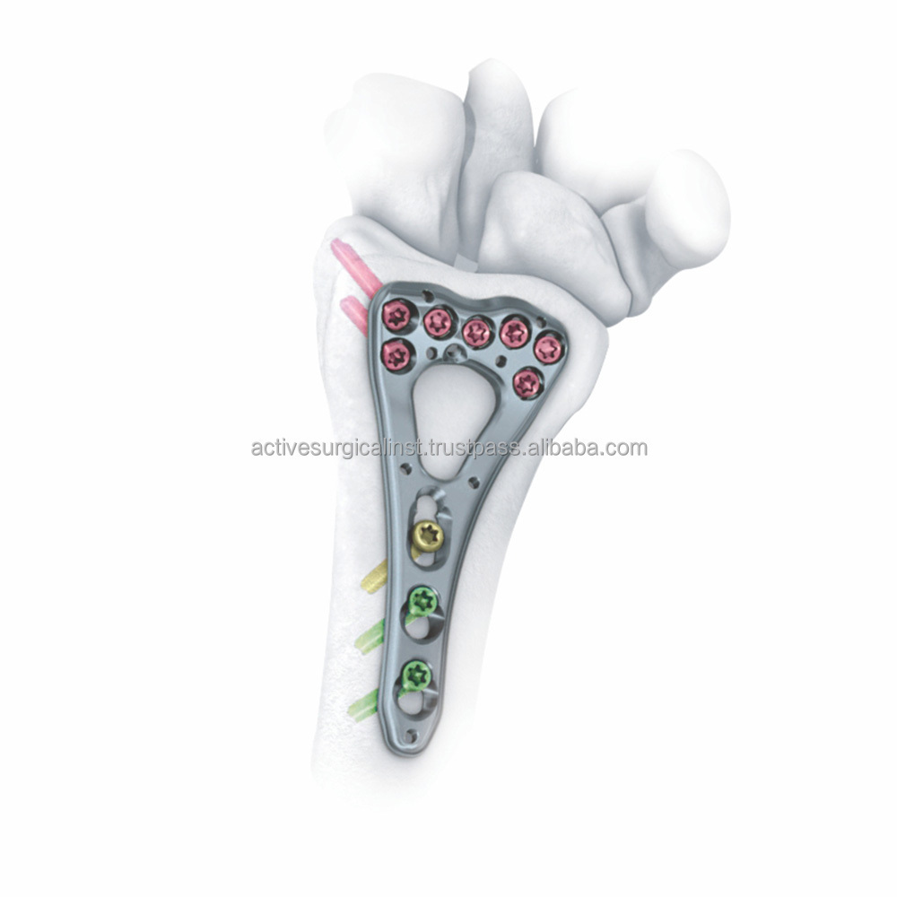 Superior Quality Variable Angle Two Column Volar Distal Radius Plate Locking 2.00 mm Titanium Surgical Orthopedic Instruments CE