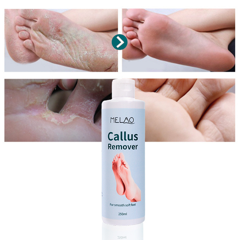 Private Label Whitening Foot Exfoliation Remover Dead Skin Eliminator moisturizing anti inflammatory Foot Exfoliator Gel