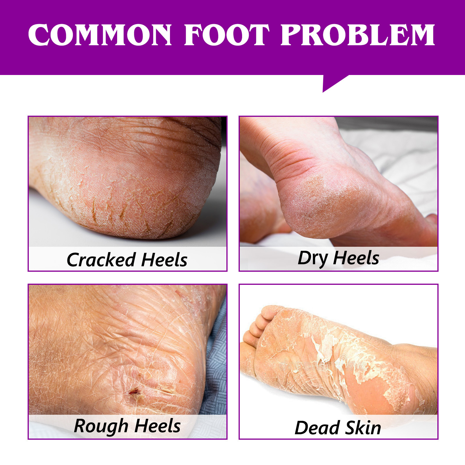 Professional Skin Deep Moisturizing Foot Healing Cream Cracked Heel Repair Balm Stick for Dry Cracked Feet Treatment