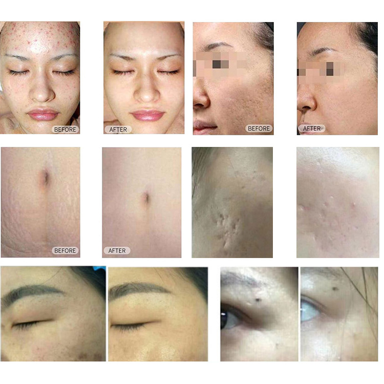 Fractional Laser Superfical Two-way Lifting peeling FRA C3 Skin Rejuvenation Technology Smooth Er 4D Pro Laser