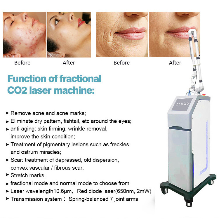 Co2 Lazer Machine For Skin Acne Scar Laser Vaginal Tightening Machine Co2 Laser Warts Removal Machine Co2 Laser Face