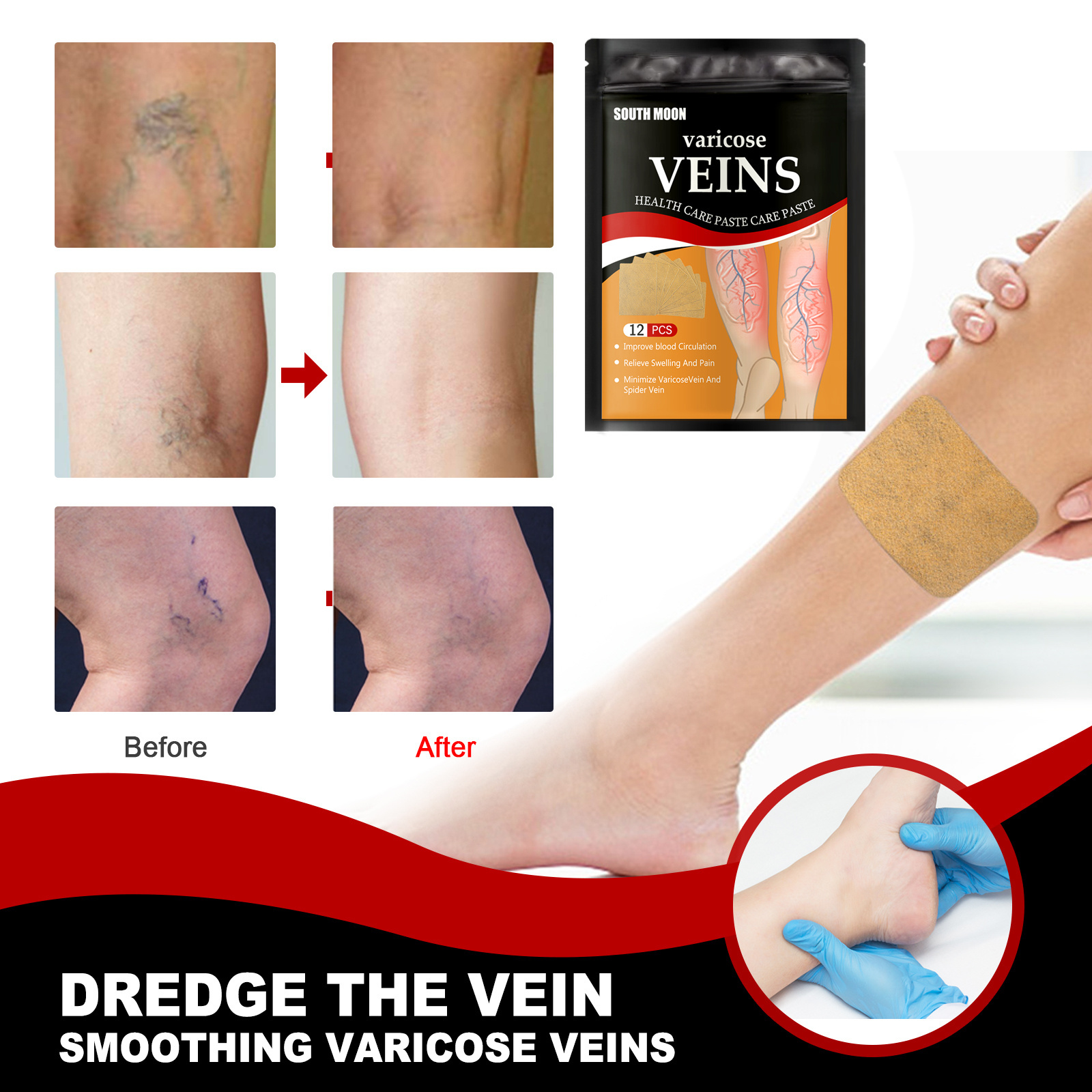 Chinese Herbal plaster vasculitis Joint muscle Pain Relief varicose vein removal patch