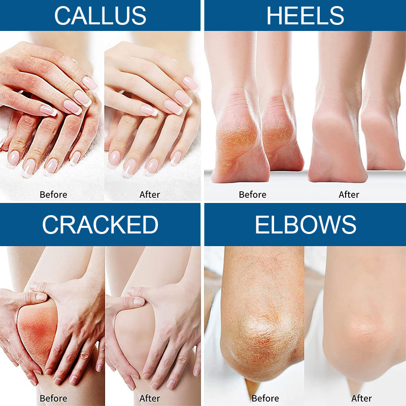 Best Feet hand Care Exfoliation Dead Skin Removal Callus 40% Urea Cracked Heel Repair Cream Moisturizing Foot Cream