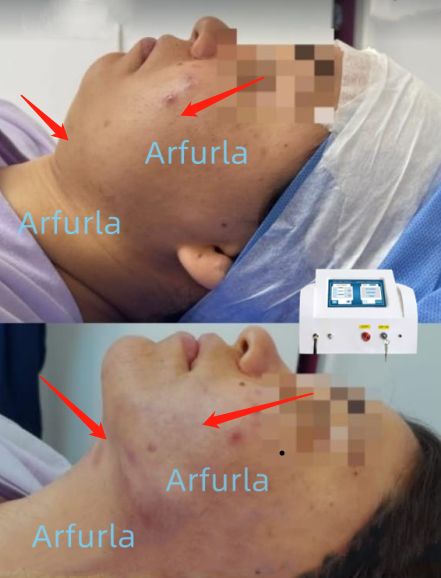 Arfurla portable vaser liposuction diode laser 980nm 1470nm vaser lipo laser machine liposuction body slimming laser