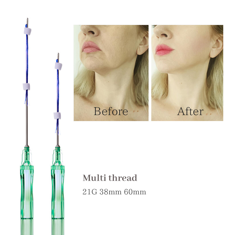 Thread Lifting Medical PCL Thread For Wrinkle Remover Or Facial Treatment Multi L Needle 21G 60mm Thread