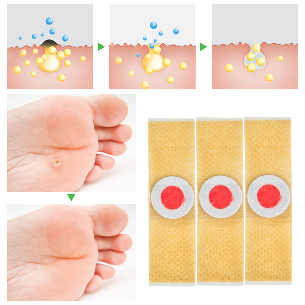 Cheap Foot Care Stickers Chicken Eye Corns Patches Medical Plaster Foot Corn Remover