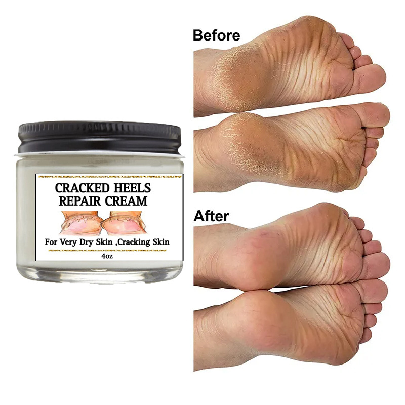 OEM ODM Cracked Heel Repair Tough Callus Remover Gel Callus Remover Cracked heels cream For Feet