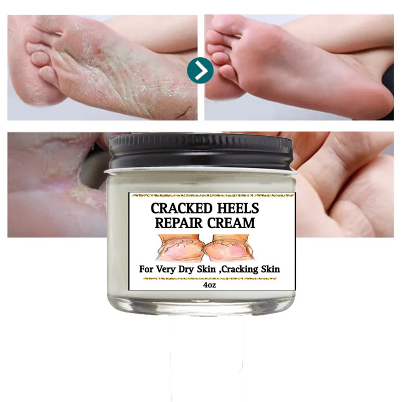 OEM ODM Cracked Heel Repair Tough Callus Remover Gel Callus Remover Cracked heels cream For Feet