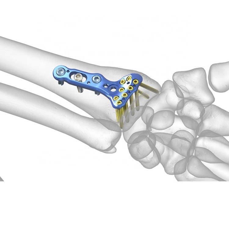 Titanium Orthopedic Implant Distal Radius Volar Locking Compression Plate And Screws Trauma Instrument Locking Plate