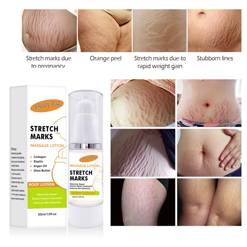 Organic Stretch Mark Remove Cream Skin Repair Anti Vergeture for Pregnancy Repair Scar Marks Stretch Mark Cream Natural Quantity