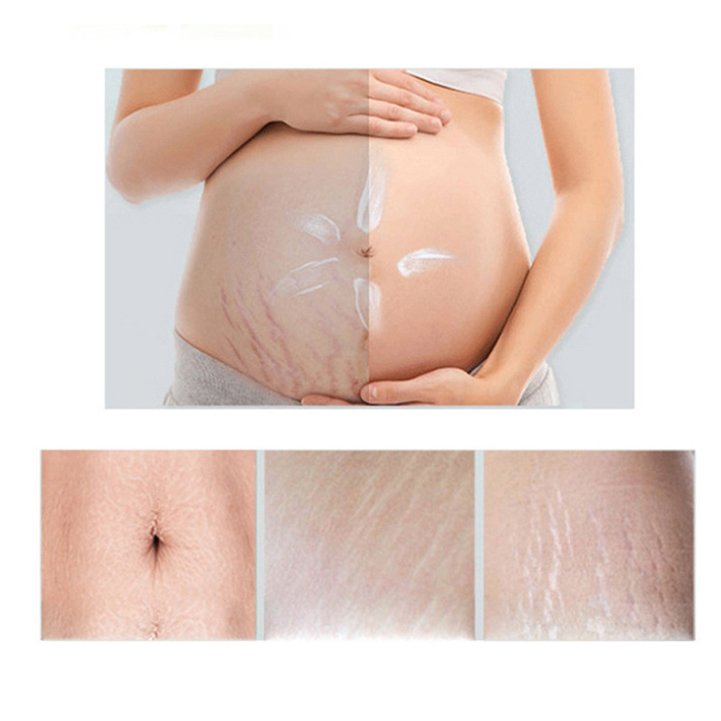 Natural Organic Stretch Mark Remove Cream Skin Repair Quantity Anti Vergeture for Pregnancy Repair Scar Marks Stretch Mark Cream