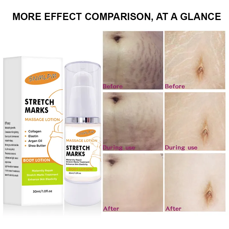 Organic Stretch Mark Remove Cream Skin Repair Anti Vergeture for Pregnancy Repair Scar Marks Stretch Mark Cream Natural Quantity