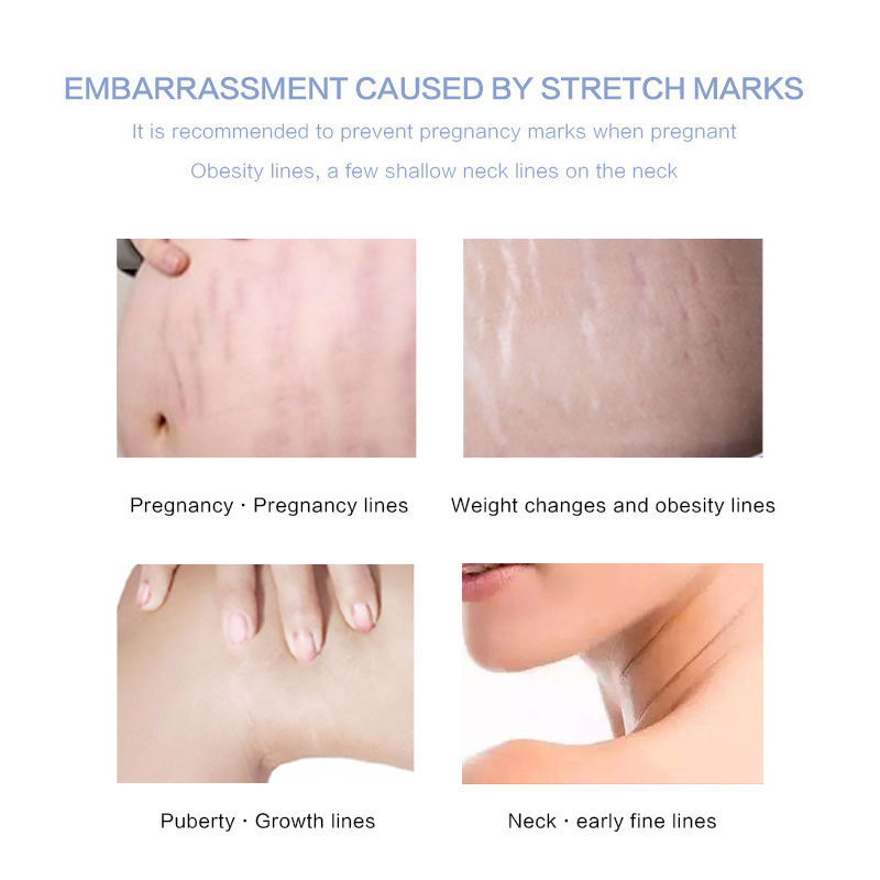 Natural Organic Stretch Mark Remove Cream Skin Repair Quantity Anti Vergeture for Pregnancy Repair Scar Marks Stretch Mark Cream