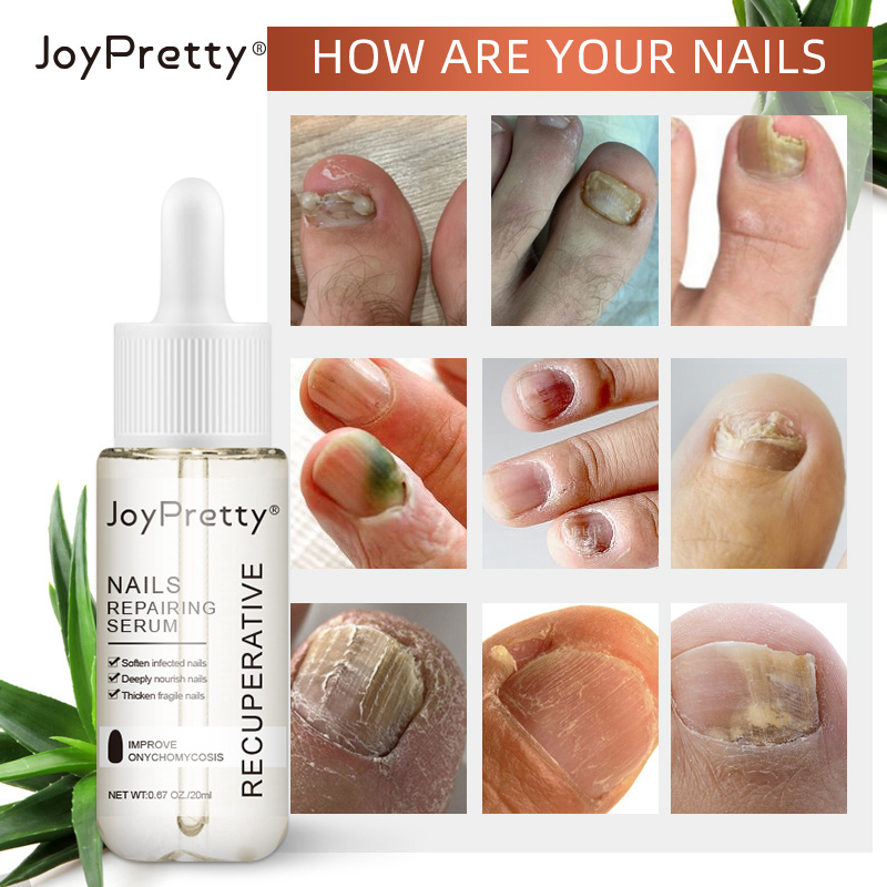 Anti Fungal Nail Herbal Treatment Feet Care Serum Onychomycosis Paronychia Nails Lotion For Nail Fungus