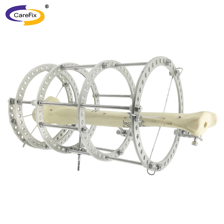 Orthopedic Fixation Surgery Fixation Equipment Large Fragment External Fixation