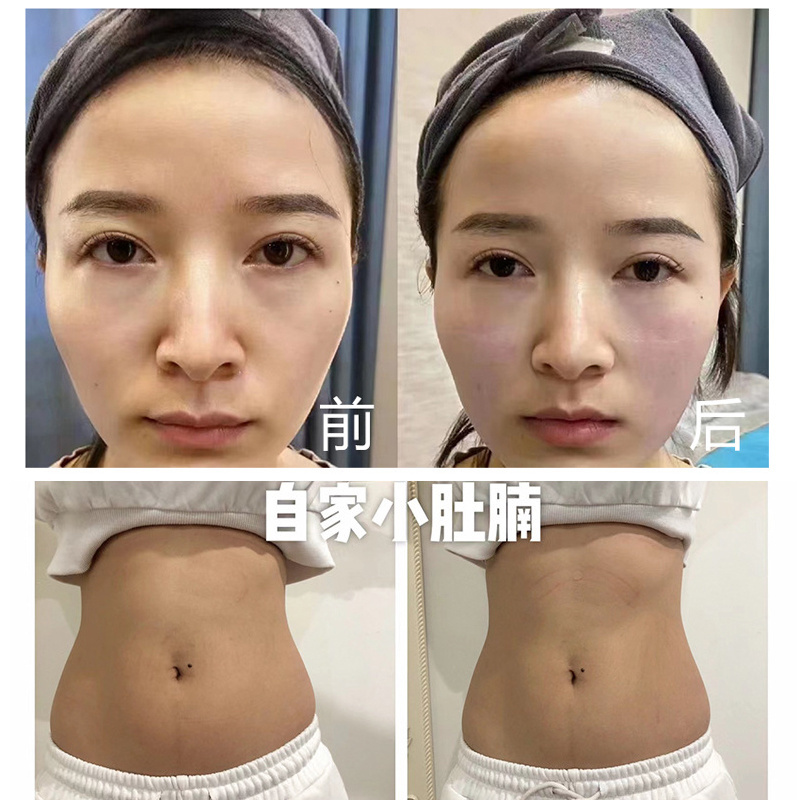 2023 Facial Face Lift Machine Exil Ultra360 Mono Rf Skin Tightening machine for weight loss Eye Lifting Eye Bag Wrinkle Removal