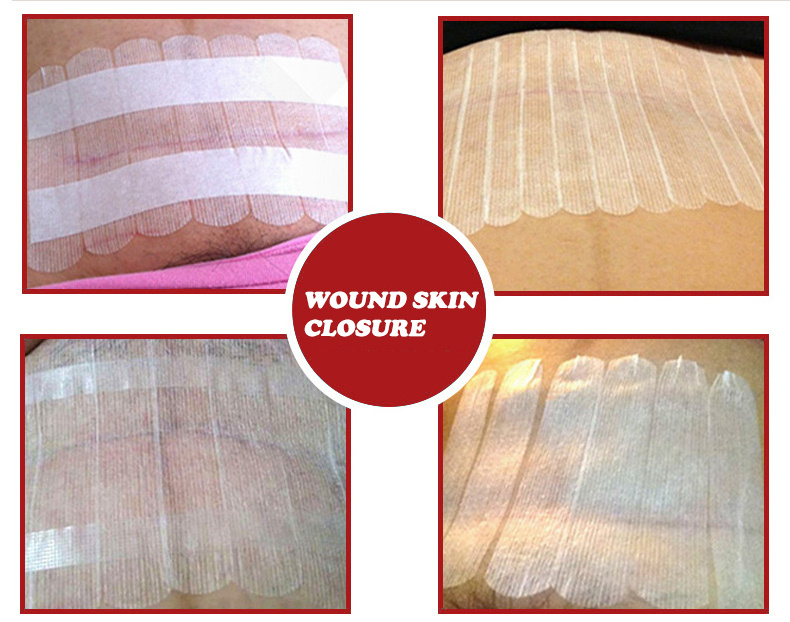 Medical Grade Adhesive Wound Skin Closure Safe Non Woven Wound Skin Closure Strips