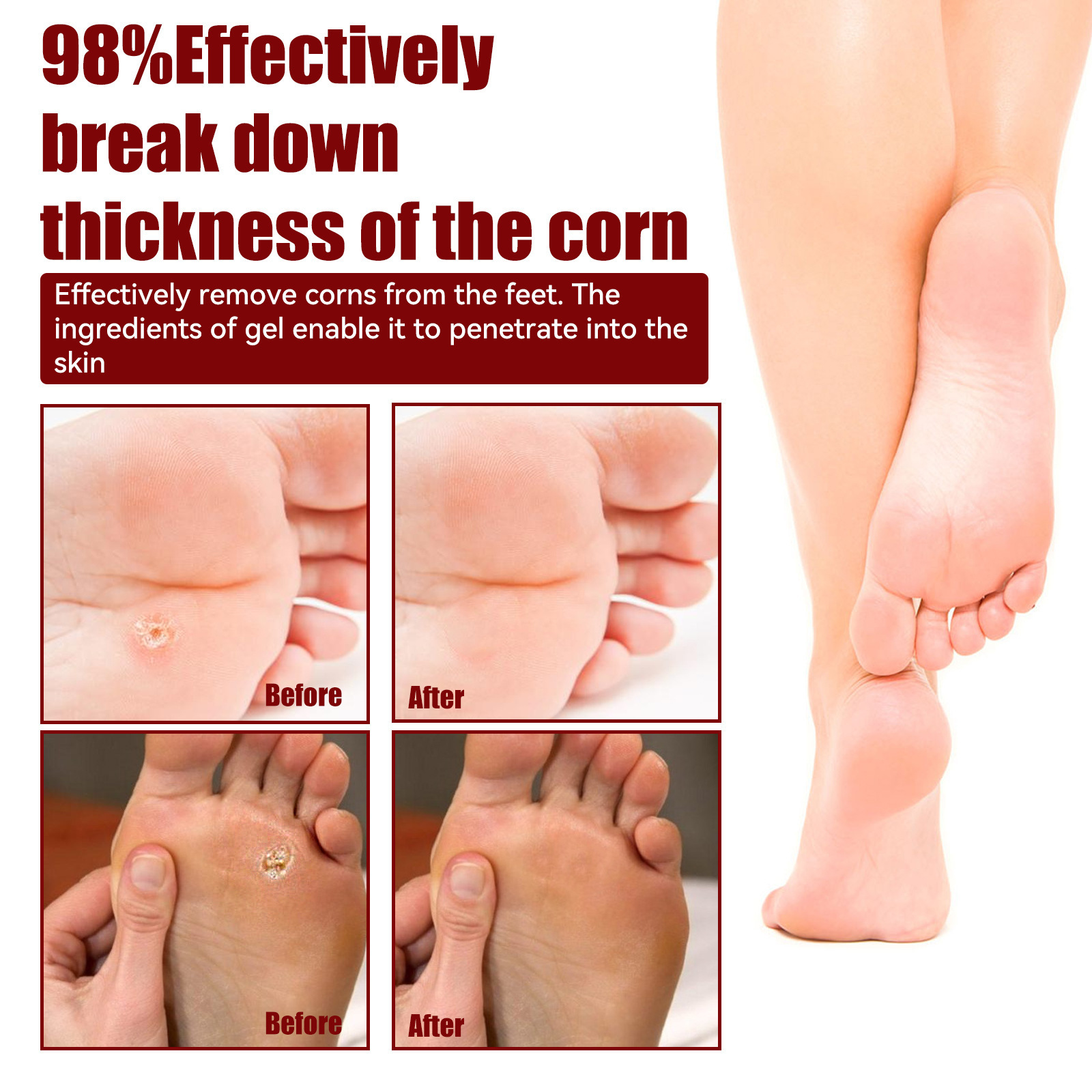 South Moon Foot corns exfoliating gel Hand and foot wart Thorn calluses skin smooth repair clear