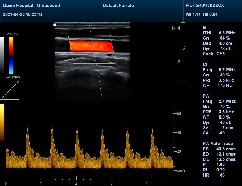 Android USB linear high frequency ultrasound probe medical probe price for MSK