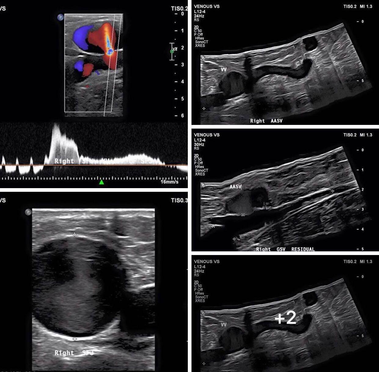 Android USB linear high frequency ultrasound probe medical probe price for MSK