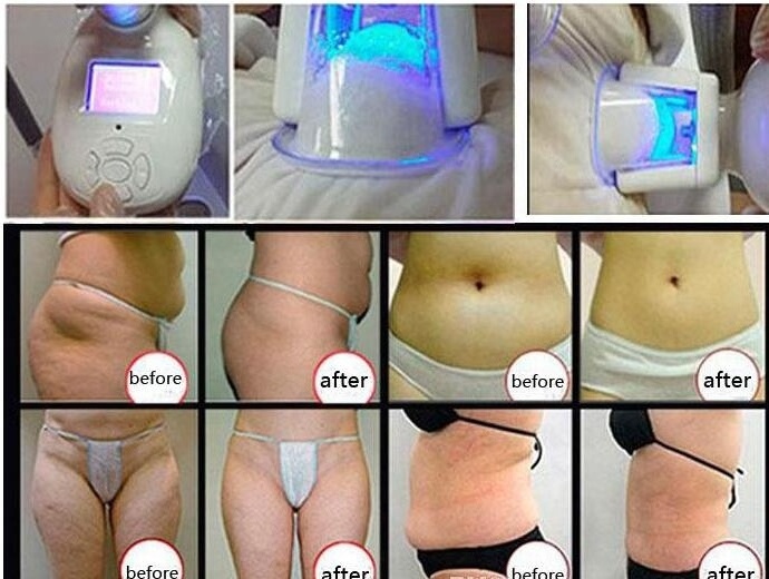 Portable 5 in 1 Cavitation Cold Cryo Machine/Lipolysis Fat Freeze Slimming Machine Price