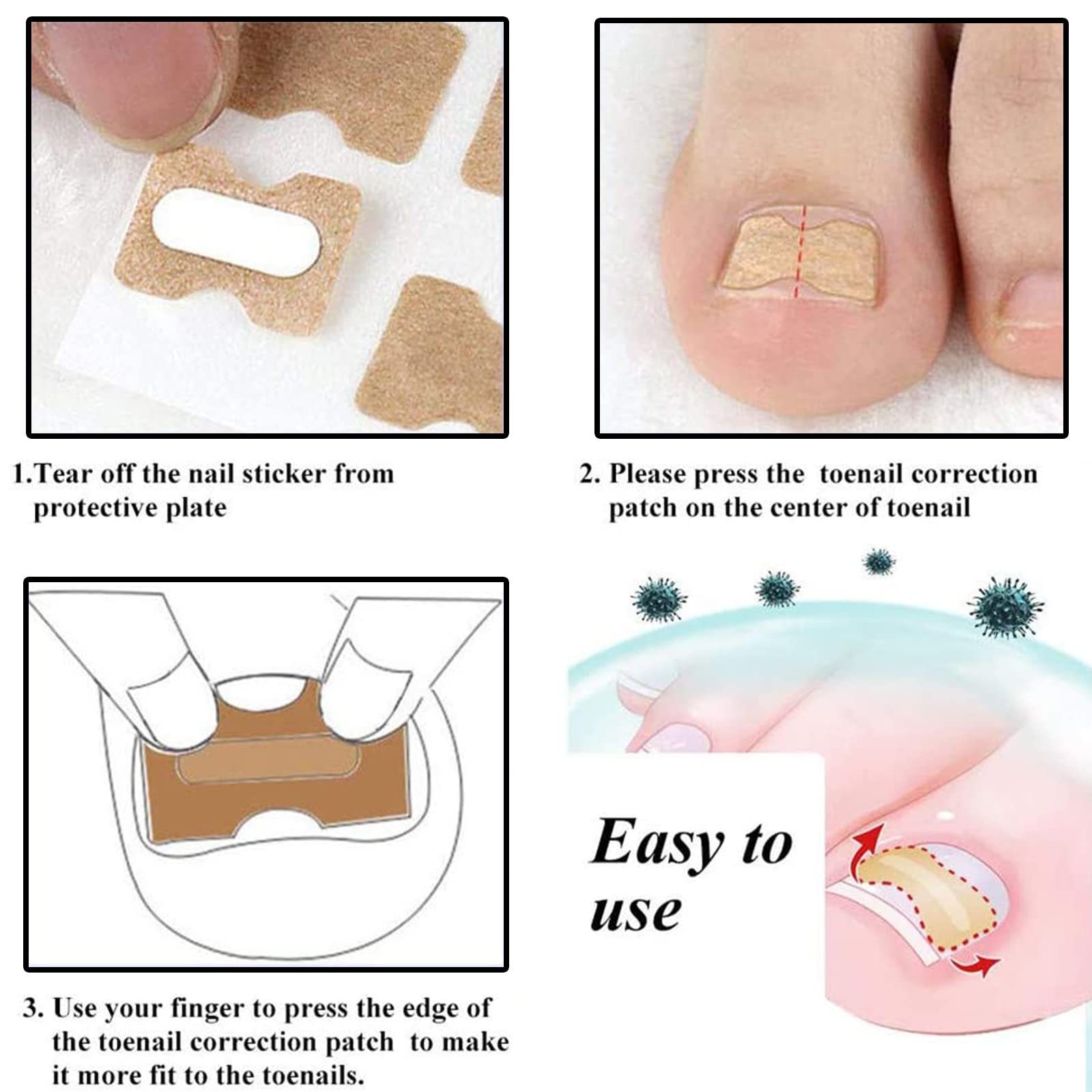 Ingrown Toenail Treatment Ingrown Toenail Removal Kit with Pedicure Toenail Corrector Patch