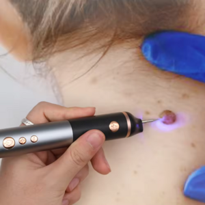 trending products 2024 Black Spot Wart Removal Pen Skin Label Removal Laser Plasma Pen Laser Plasma Pen Skin label removal