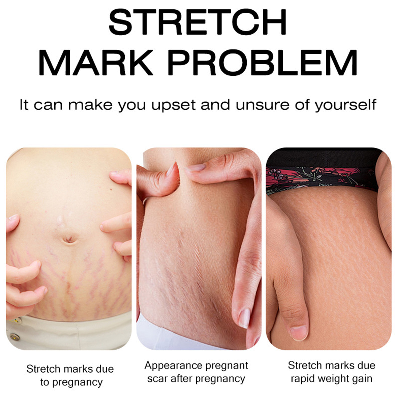 Effective Scar Removal Face Cream Acne Pimples Stretch Marks Remove Cream Smoothing Firming Anti Stretch Marks Scar Repair Cream