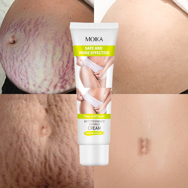 Effective Scar Removal Face Cream Acne Pimples Stretch Marks Remove Cream Smoothing Firming Anti Stretch Marks Scar Repair Cream