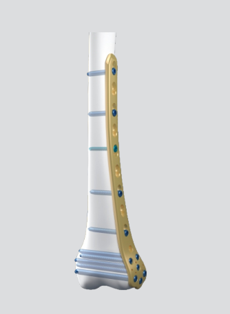 Femoral Condyle Support for Intra-Articular Fracture of Distal Femur Interventional Implants & Materials