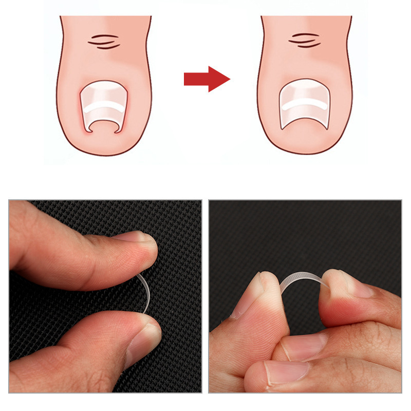 Nail Corrector Strips Brace Toe Nail Treatment Patch Sticker Corrector Pedicure Tools Toenails Correction Foot Tool