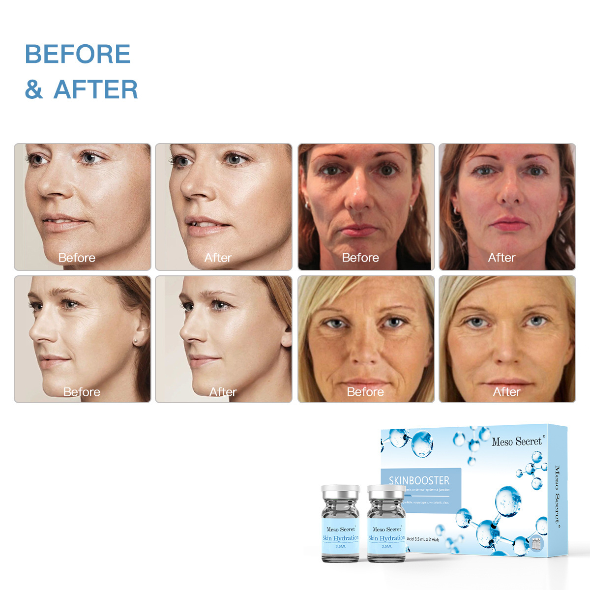 New high quality wrinkle filler face deep body injections non cross linked hyaluronic acid