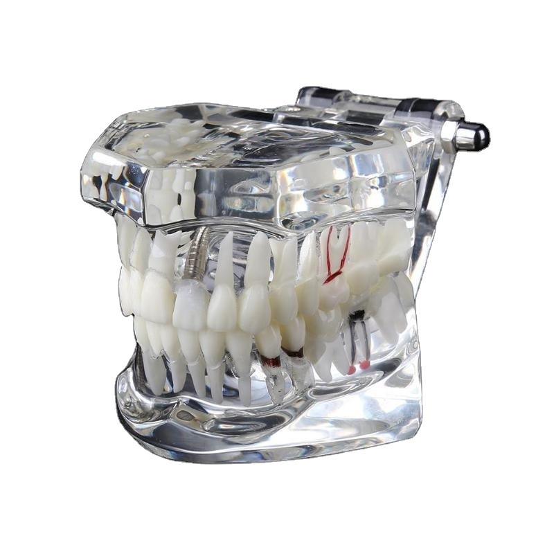 High Quality Dental Implant Disease Teaching Study Teeth Model With Restoration Bridge Tooth Dentist For Dental Lab Equipment