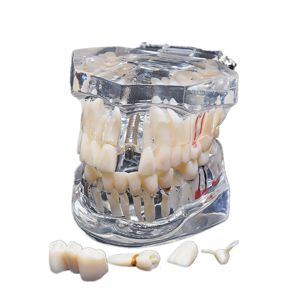 High Quality Dental Implant Disease Teaching Study Teeth Model With Restoration Bridge Tooth Dentist For Dental Lab Equipment