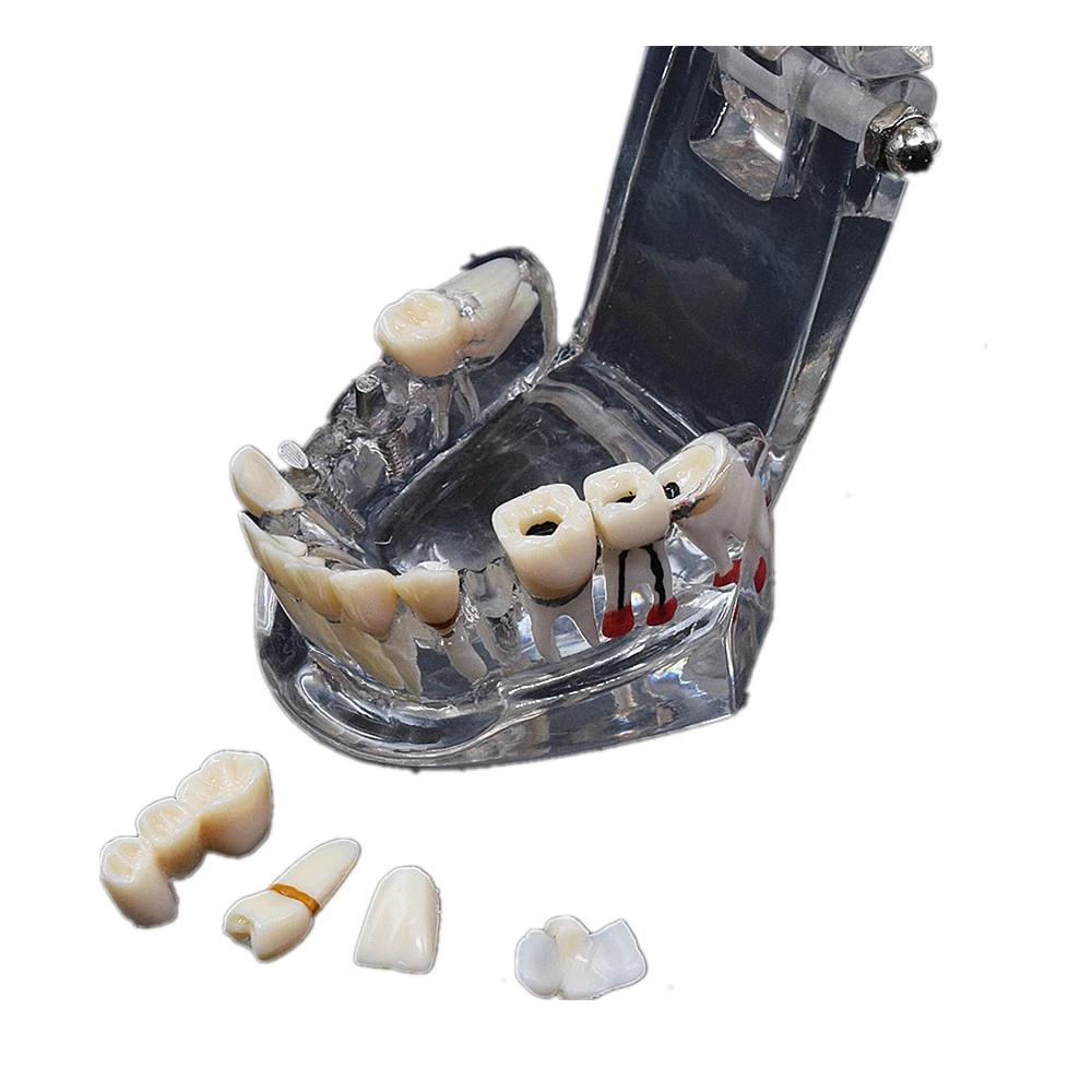 High Quality Dental Implant Disease Teaching Study Teeth Model With Restoration Bridge Tooth Dentist For Dental Lab Equipment