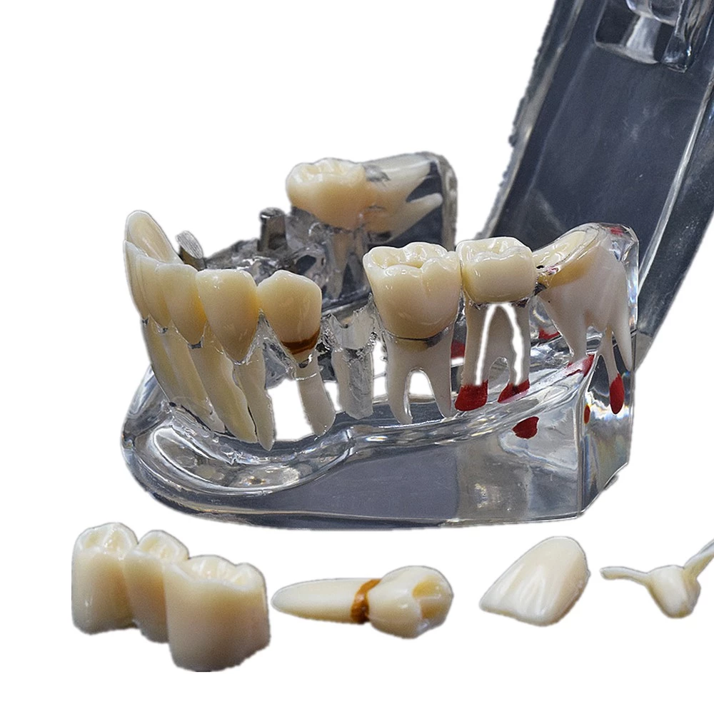 High Quality Dental Implant Disease Teaching Study Teeth Model With Restoration Bridge Tooth Dentist For Dental Lab Equipment