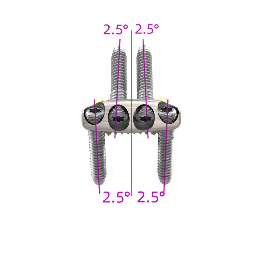 Medical Disposable Implants for Cervical Spine Fixation Zero Profile Interbody Fusion Cage with Four Screws Orthopedic Surgery