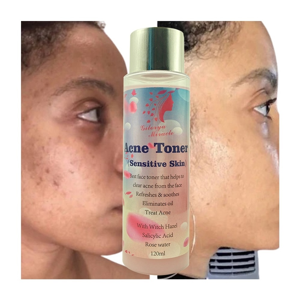 Manufacturer Clear Acne  Treat Pimple Rose Water Toner Refreshes Soothes Whitens Radiant Skin Oil Control for Black Skin