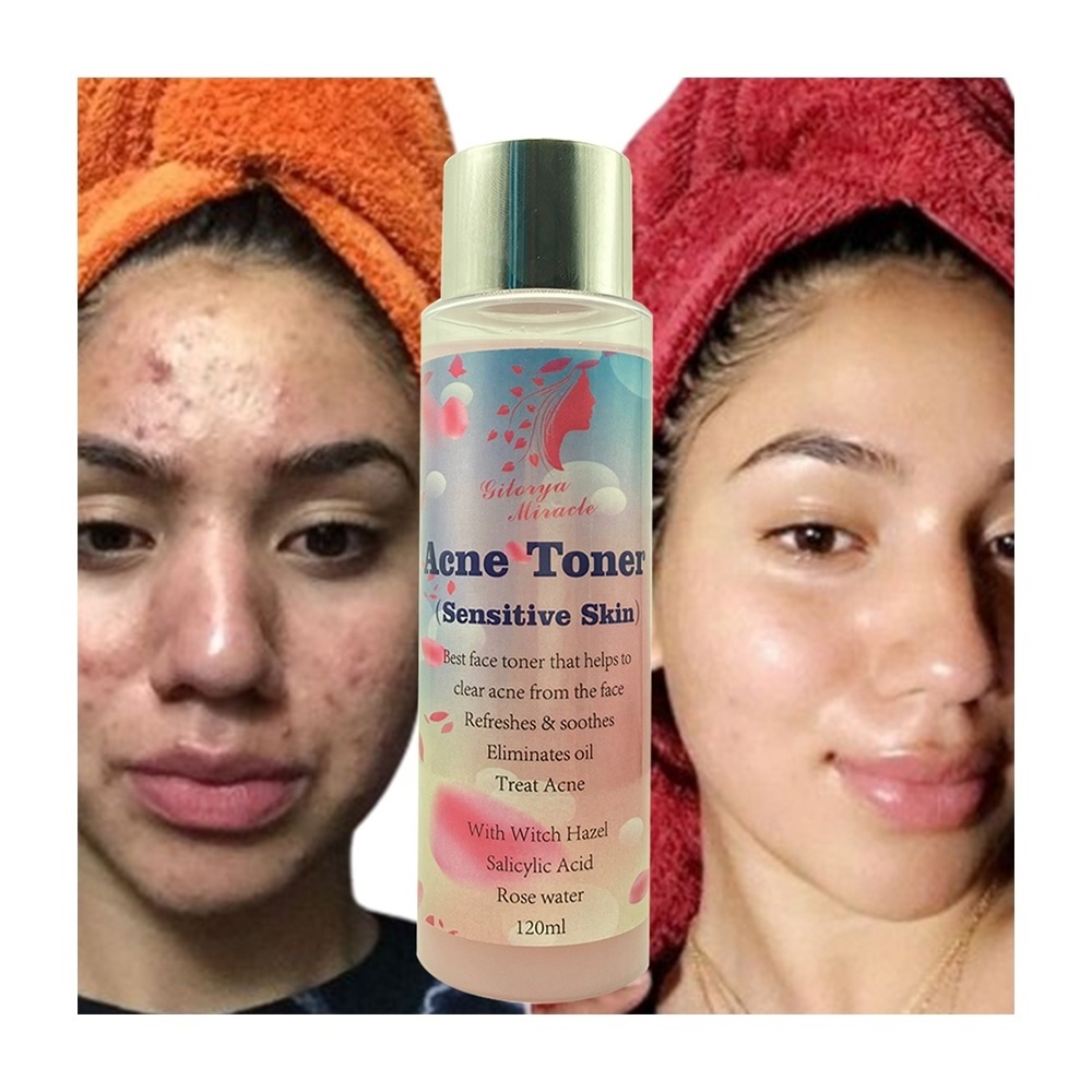 Manufacturer Clear Acne  Treat Pimple Rose Water Toner Refreshes Soothes Whitens Radiant Skin Oil Control for Black Skin