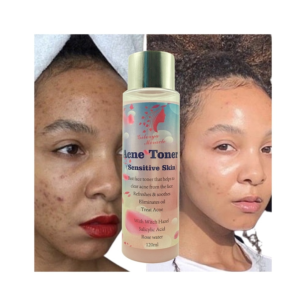 Manufacturer Clear Acne  Treat Pimple Rose Water Toner Refreshes Soothes Whitens Radiant Skin Oil Control for Black Skin