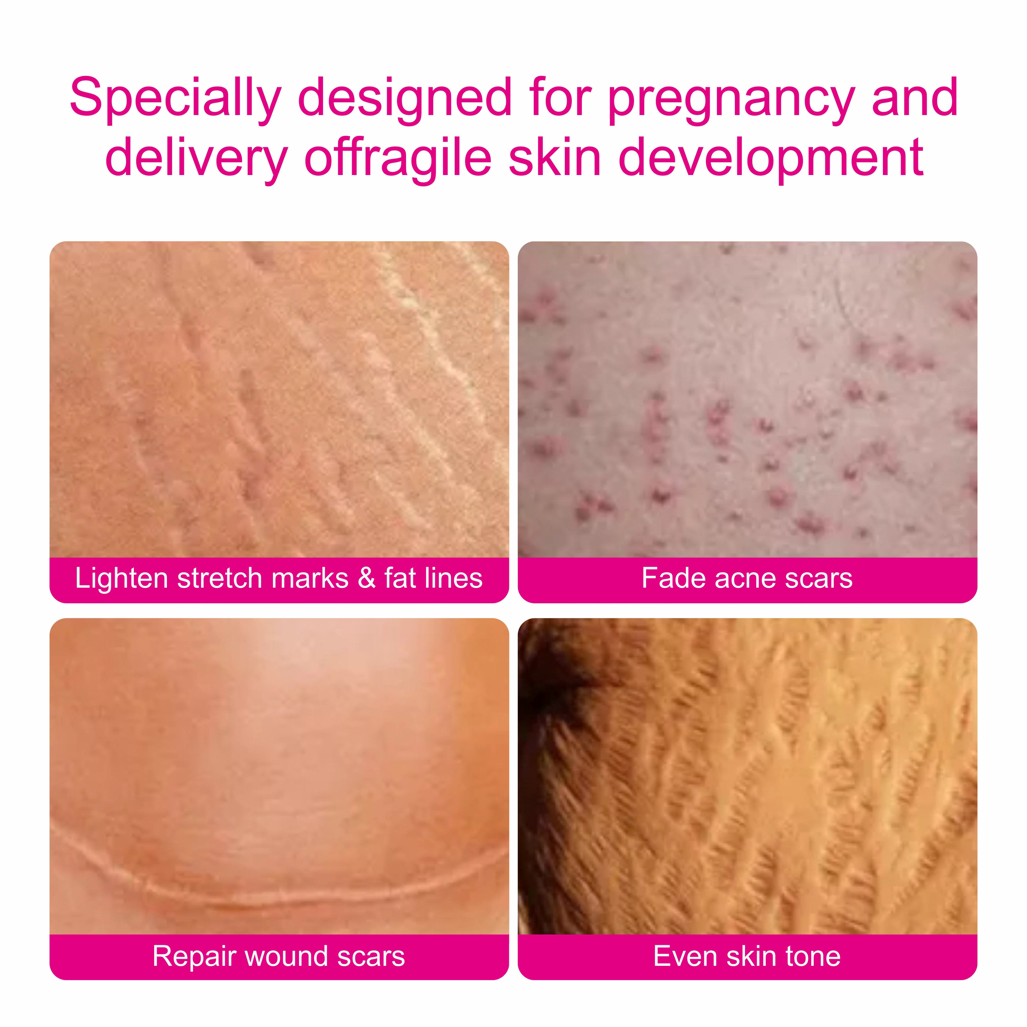 RT Skin Care Stretch Mark Removal Oil Reducing Blemish And Uneven Skin Tones Organic Scar Body Oil