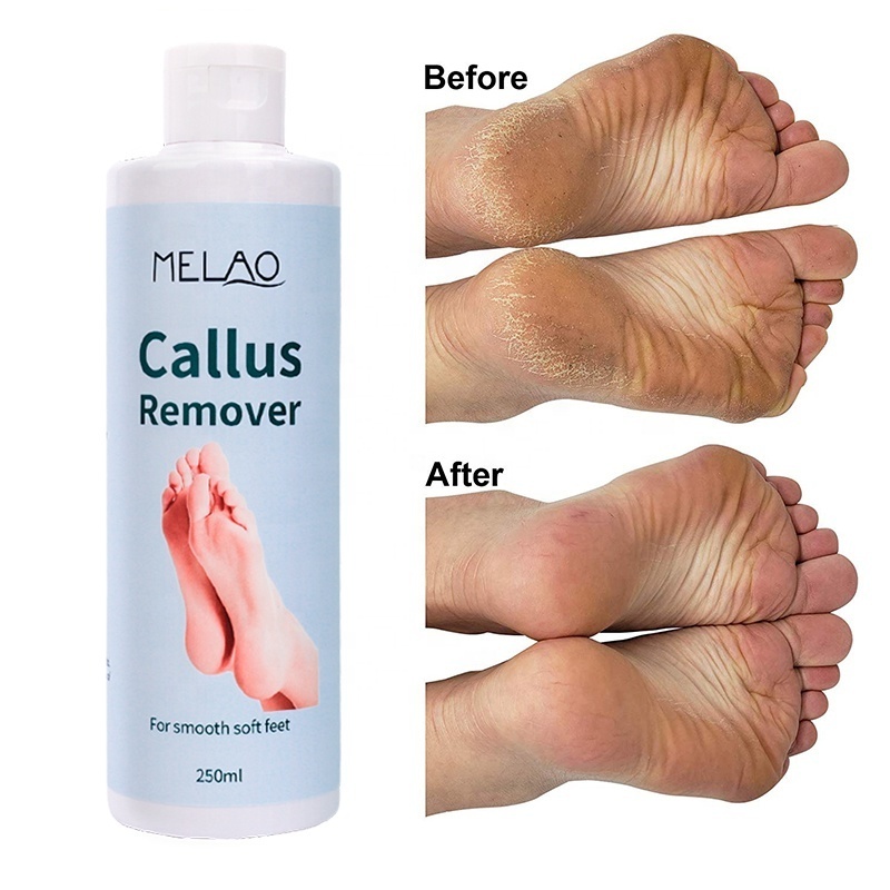 Gentle Removal Calluses Wholesale Foot Care Whitening Gel File Callus Remover Peel