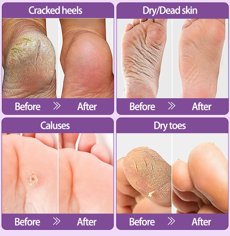 Guangzhou skin care supplier foot skin care peeling mask foot scrubs