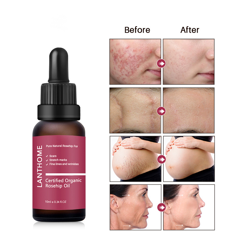 Whole sale price Skin  Whitening Rose hip oil on face Anti-Wrinkle Oil