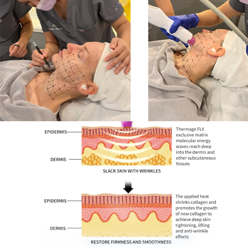 Skin Tightening Face Massager Lift Wrinkles Removal Mini RF Microneedling Radio Frequency Beauty Device thermalifting machine