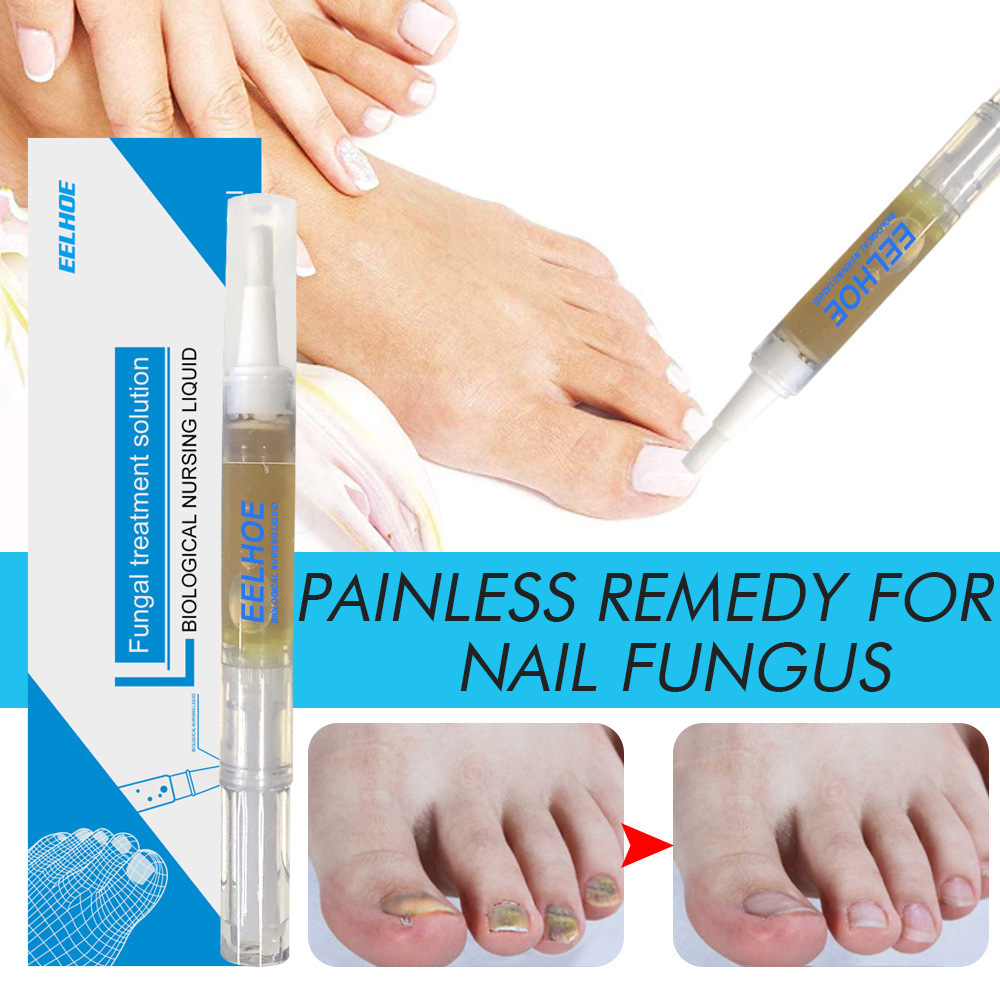 Anti Fungal Treatment Nail Pen Onychomycosis Paronychia Infection Herbal Toe Finger Repair Hand Foot Skin Care