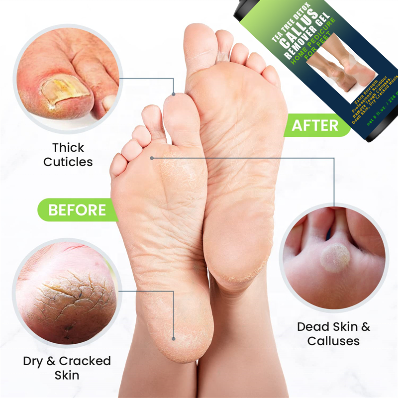 Home Pedicure Tea Tree Oil Peel Exfoliator Foot Callus Remover Cracked Heel dead cell Feet Exfoliating Gel Pumice Stone Scrubber