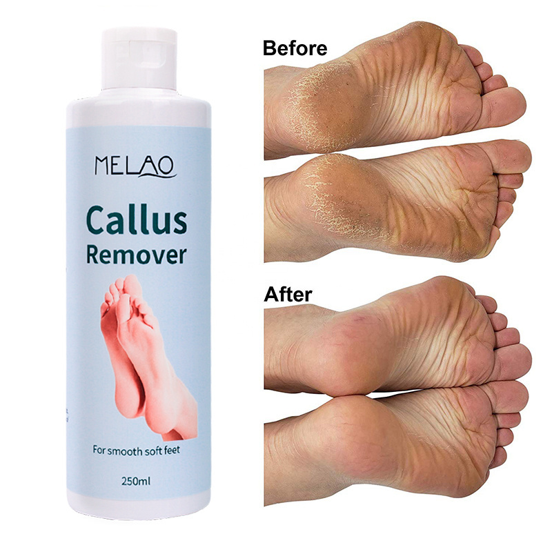 Private Label Spa Moisturizing Natural Foot Heel Gel Ankles Callus Remover Foot Callus Remover Gel for Feet