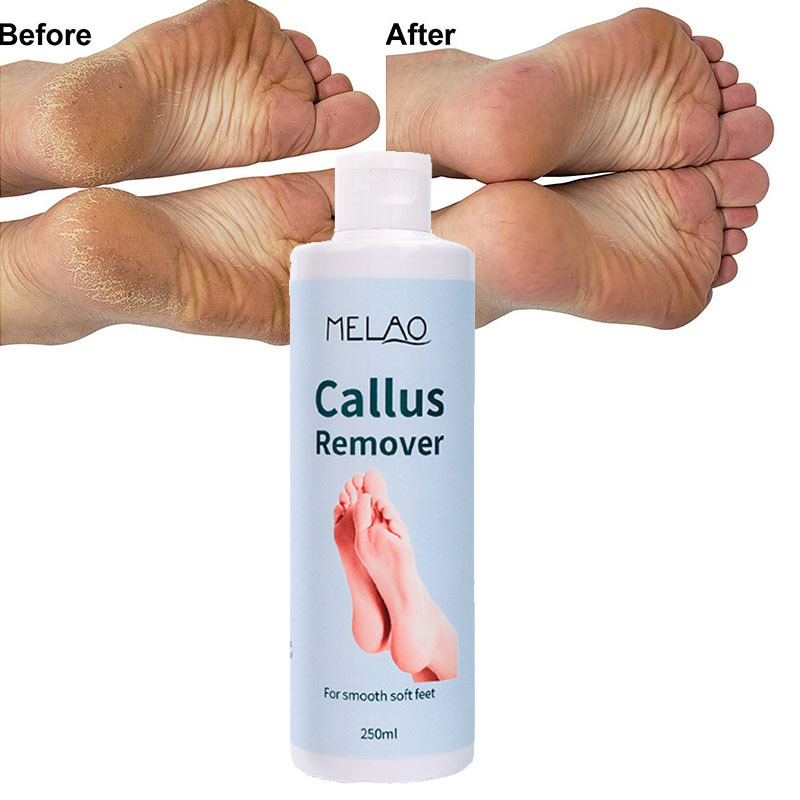 Professional Foot Callus Removal Gel Private Label Callus Remover Foot Gel For Dry Cracked Feet