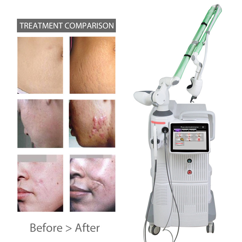 Erbium Fractional Laser Stretch Marks Removal Skin Care Beauty Equipment Fractional Co2 Laser Korea